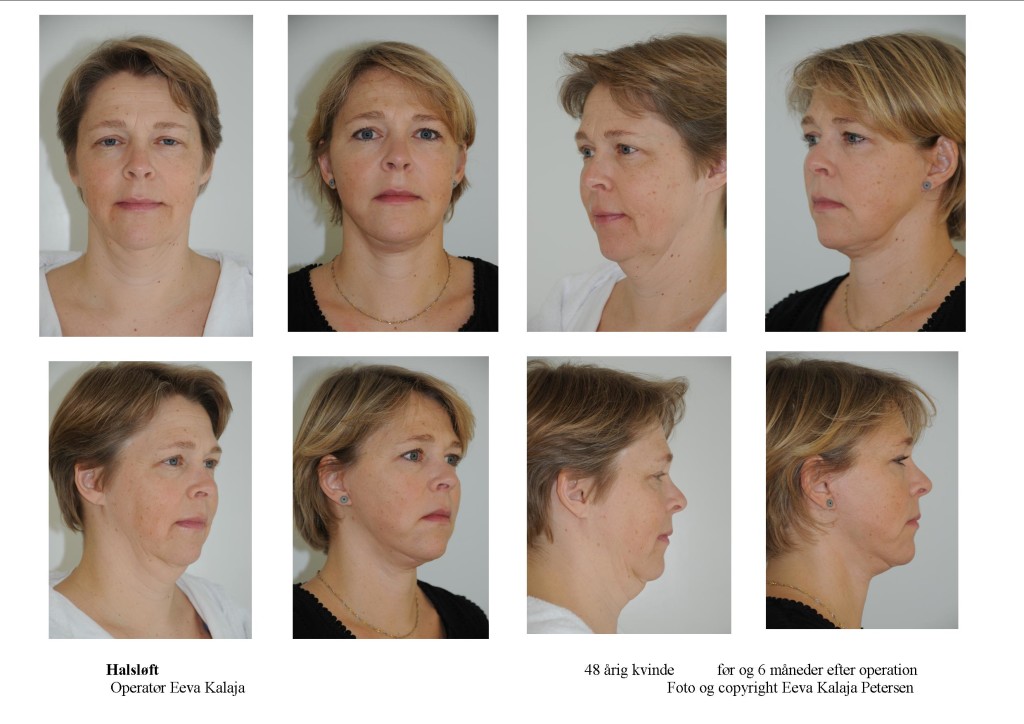 Ansigtsløftning - halsløft tryk på foto 1 eller 2 gange for detaljer
