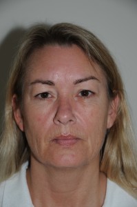 48-årig kvinde. Operation af øvre øjenlåg og slibning af rynker omkring munden