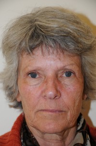 3 mdr. efter øvre øjenlågsoperation