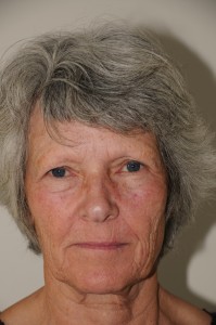 69-årig kvinde, før operation